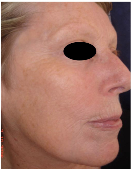 2 Months Post Thermage