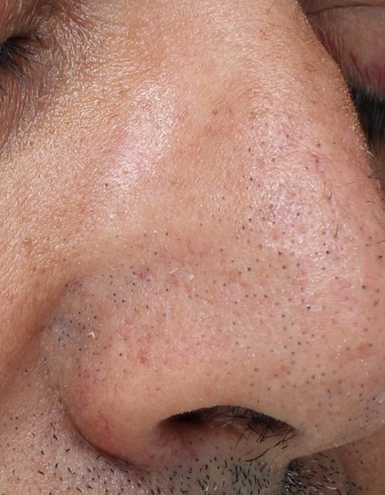 Before Hydra-dermabrasion