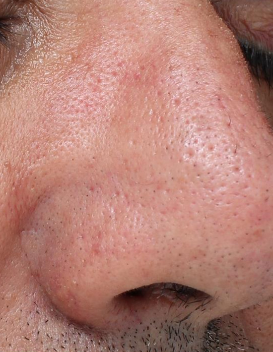 After Hydra-dermabrasion