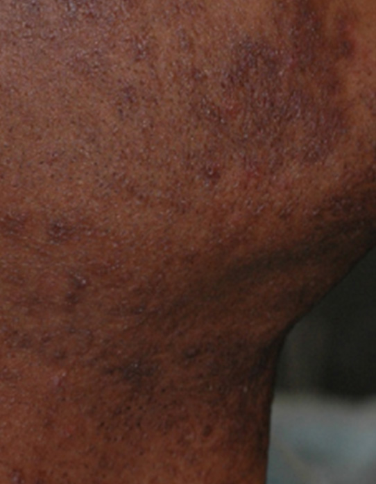 Before Pseudofolliculitis Barbae