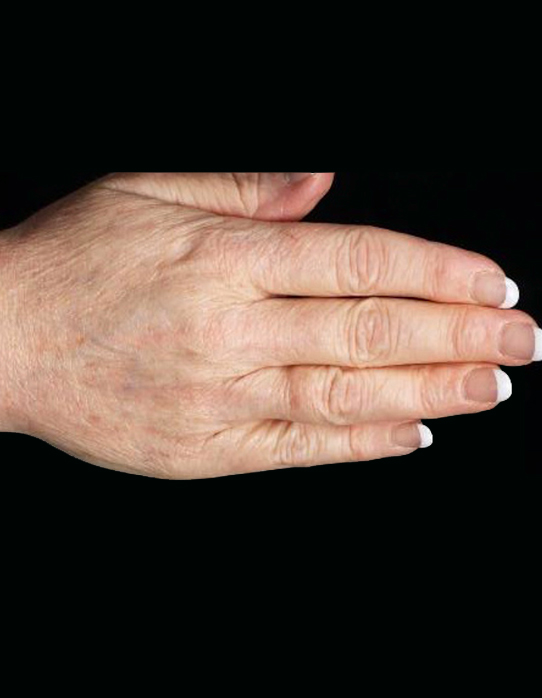 Immediately Post Thermage & 1 Month Post 2 Fraxel treatments