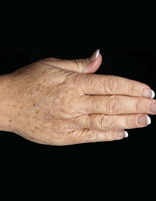 Before Thermage and Fraxel