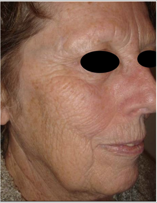 Before Thermage and Fraxel