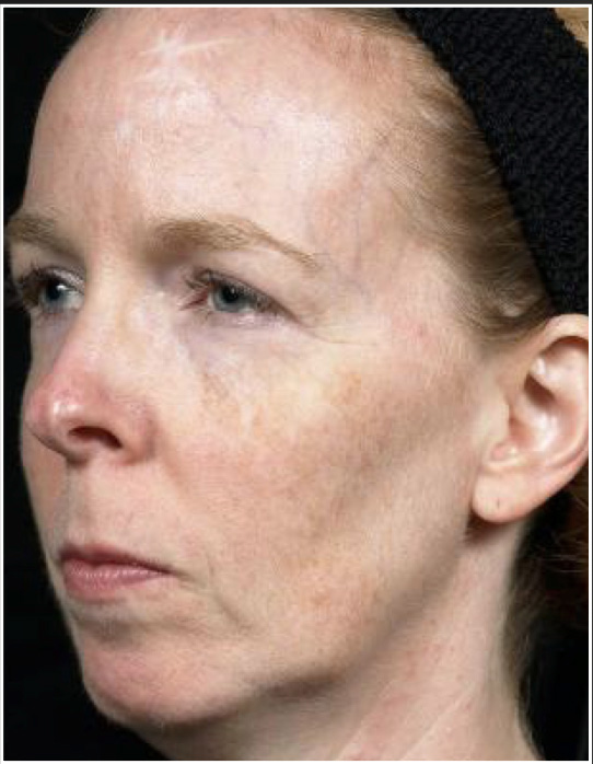 Before Thermage and Fraxel