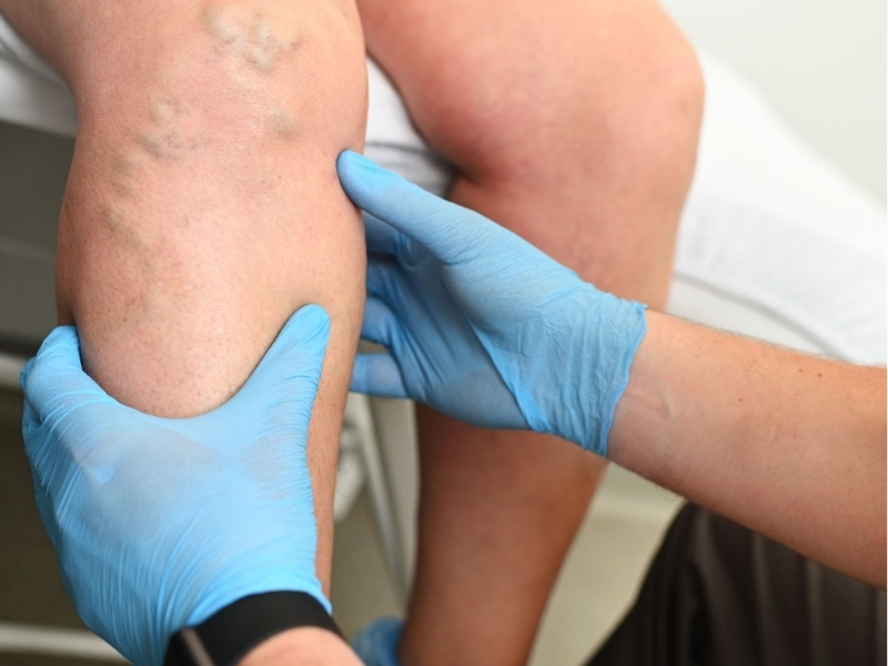 Lymphedema Surgery